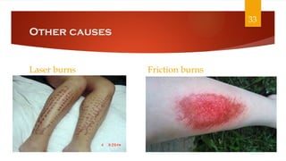 Friction Burn Def BURNS REHABILITATION - Copy.pptx burns ppt | PPTX