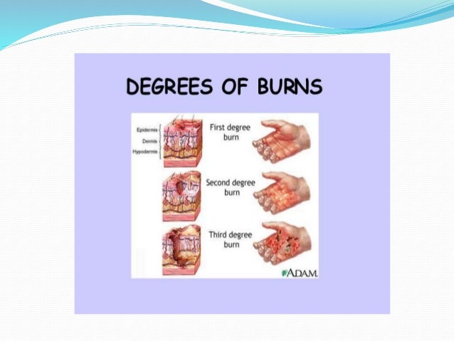 2nd or 3rd degree burn 2nd or 3rd degree burn