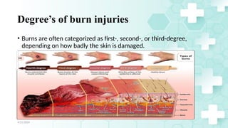 Jamal 14
Degree’s of burn injuries
• Burns are often categorized as first-, second-, or third-degree,
depending on how badly the skin is damaged.
4/21/2024
 
