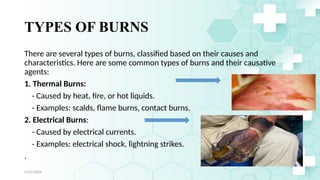 Jamal 8
TYPES OF BURNS
There are several types of burns, classified based on their causes and
characteristics. Here are some common types of burns and their causative
agents:
1. Thermal Burns:
- Caused by heat, fire, or hot liquids.
- Examples: scalds, flame burns, contact burns.
2. Electrical Burns:
- Caused by electrical currents.
- Examples: electrical shock, lightning strikes.
.
4/21/2024
 