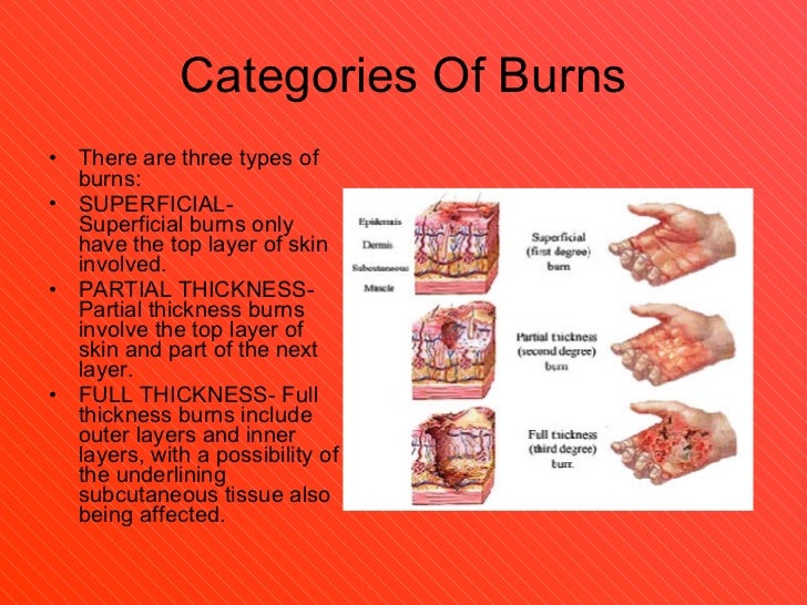 Burns pictures
