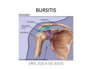 BURSITIS




DRA. ZOILA DE JESUS
 