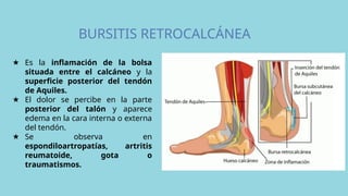 BURSITIS RETROCALCÁNEA
★ Es la inflamación de la bolsa
situada entre el calcáneo y la
superficie posterior del tendón
de Aquiles.
★ El dolor se percibe en la parte
posterior del talón y aparece
edema en la cara interna o externa
del tendón.
★ Se observa en
espondiloartropatías, artritis
reumatoide, gota o
traumatismos.
 