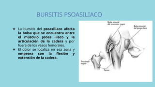 BURSITIS PSOASILIACO
★ La bursitis del psoasiliaco afecta
la bolsa que se encuentra entre
el músculo psoas iliaco y la
articulación de la cadera y por
fuera de los vasos femorales.
★ El dolor se localiza en esa zona y
empeora con la flexión y
extensión de la cadera.
 