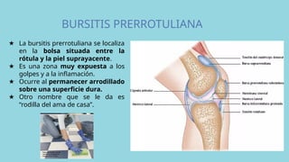 BURSITIS PRERROTULIANA
★ La bursitis prerrotuliana se localiza
en la bolsa situada entre la
rótula y la piel suprayacente.
★ Es una zona muy expuesta a los
golpes y a la inflamación.
★ Ocurre al permanecer arrodillado
sobre una superficie dura.
★ Otro nombre que se le da es
“rodilla del ama de casa”.
 