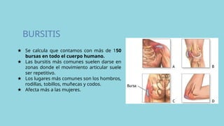 BURSITIS
★ Se calcula que contamos con más de 150
bursas en todo el cuerpo humano.
★ Las bursitis más comunes suelen darse en
zonas donde el movimiento articular suele
ser repetitivo.
★ Los lugares más comunes son los hombros,
rodillas, tobillos, muñecas y codos.
★ Afecta más a las mujeres.
 