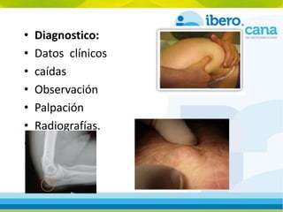 • Diagnostico:
• Datos clínicos
• caídas
• Observación
• Palpación
• Radiografías.
• Fisioterapia.
 