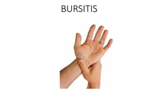 BURSITIS
 