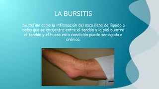 LA BURSITIS
Se define como la inflamación del saco lleno de líquido o
bolsa que se encuentra entre el tendón y la piel o entre
el tendón y el hueso esta condición puede ser aguda o
crónica.
 