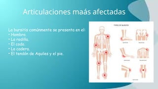 Articulaciones maás afectadas
La bursitis comúnmente se presenta en el:
• Hombro.
• La rodilla.
• El codo.
• La cadera.
• El tendón de Aquiles y el pie.
 