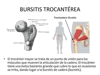 BURSITIS TROCANTÉREA




• El trocánter mayor se trata de un punto de unión para los
  músculos que mueven la articulación de la cadera. El trocánter
  tiene una bolsa bastante grande que cubre lo que en ocasiones
  se irrita, dando lugar a la bursitis de cadera (bursitis).
 