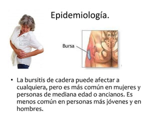 Epidemiología.




• La bursitis de cadera puede afectar a
  cualquiera, pero es más común en mujeres y
  personas de mediana edad o ancianos. Es
  menos común en personas más jóvenes y en
  hombres.
 
