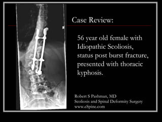 Case Review:

 56 year old female with
 Idiopathic Scoliosis,
 status post burst fracture,
 presented with thoracic
 kyphosis.


Robert S Pashman, MD
Scoliosis and Spinal Deformity Surgery
www.eSpine.com
 