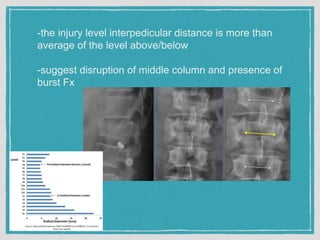 -the injury level interpedicular distance is more than
average of the level above/below
-suggest disruption of middle column and presence of
burst Fx
 