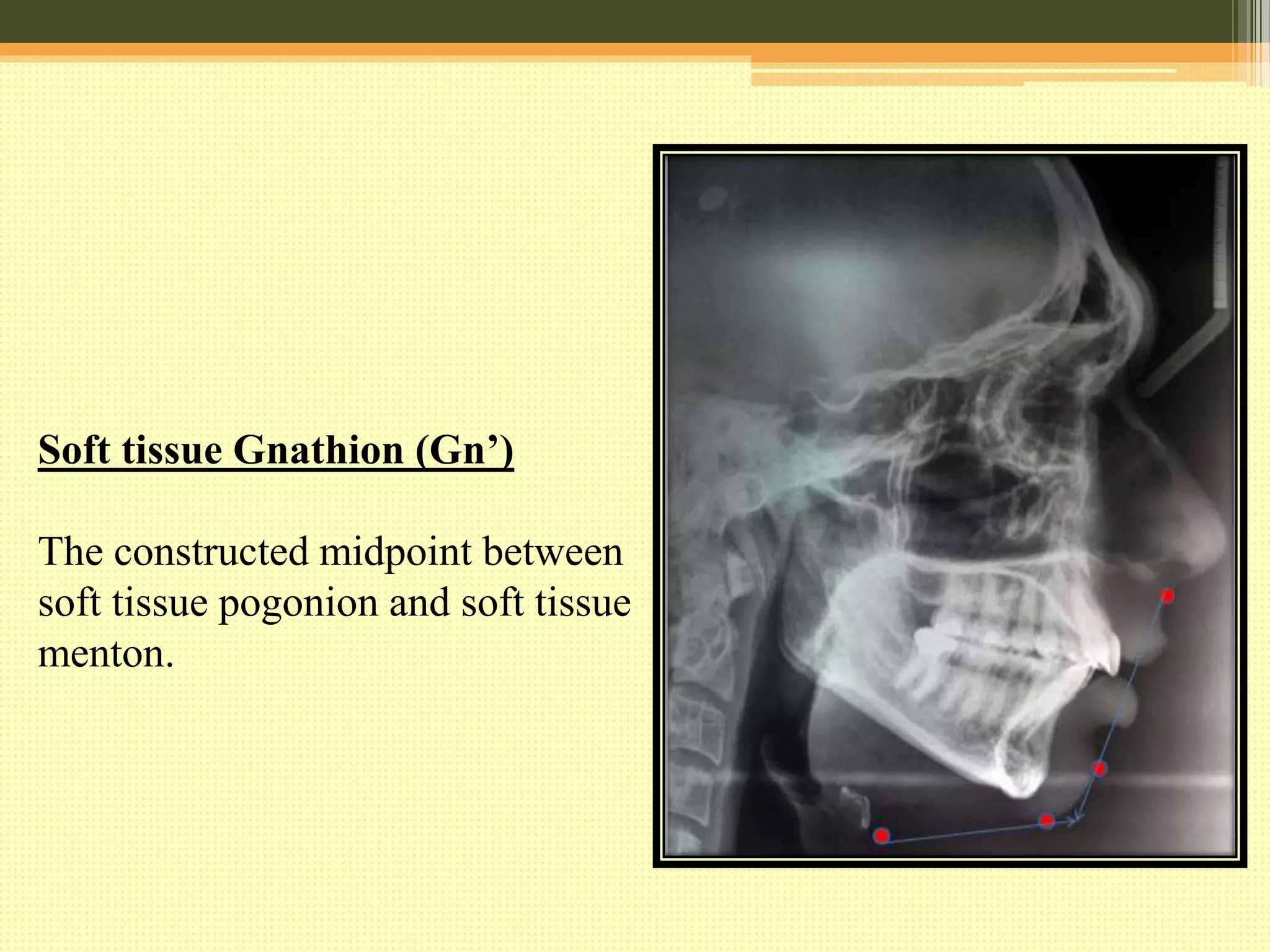 BURSTONE ANALYSIS : C.O.G.S ( HARD & SOFT TISSUE) | PPTX