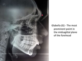 Glabella (G) - The most
prominent point in
the midsagittal plane
of the forehead
 