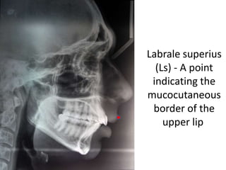 Labrale superius
(Ls) - A point
indicating the
mucocutaneous
border of the
upper lip
 