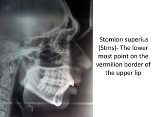 Stomion superius
(Stms)- The lower
most point on the
vermilion border of
the upper lip
 