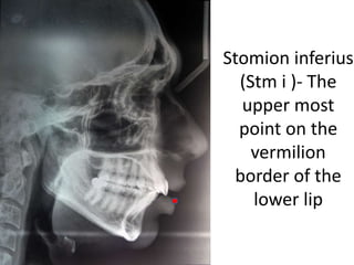 Stomion inferius
(Stm i )- The
upper most
point on the
vermilion
border of the
lower lip
 