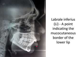 Labrale inferius
(Li) - A point
indicating the
mucocutaneous
border of the
lower lip
 