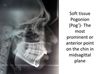 Soft tissue
Pogonion
(Pog’)- The
most
prominent or
anterior point
on the chin in
midsagittal
plane
 
