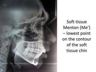 Soft tissue
Menton (Me’)
– lowest point
on the contour
of the soft
tissue chin
 
