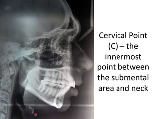 Cervical Point
(C) – the
innermost
point between
the submental
area and neck
 