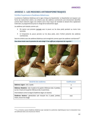ANNEXES
141
ANNEXE 1 : LES MESURES ANTHROPOMETRIQUES
Vérifier la présence d’œdèmes bilatéraux
La présence d’œdèmes bilatéraux est le signe clinique du Kwashiorkor. Le Kwashiorkor est toujours une
forme de malnutrition sévère. Les enfants avec des œdèmes nutritionnels sont directement identifiés
comme étant malnutris aiguë. Ces enfants sont à haut risque de mortalité et doivent être rapidement
traité dans un programme de prise en charge de la malnutrition aiguë.
Les œdèmes sont évalués comme suit :
• On exerce une pression normale avec le pouce sur les deux pieds pendant au moins trois
secondes.
• Si l’empreinte du pouce persiste sur les deux pieds, alors l’enfant présente des œdèmes
nutritionnels.
Seuls les enfants avec des œdèmes bilatéraux sont enregistrés comme ayant des œdèmes nutritionnels70
Vous devez tester avec la pression de votre doigt ! Il ne suffit pas uniquement de regarder !
Sévérité des œdèmes Codification
Œdèmes Légers : des 2 pieds +
Œdèmes Modérés : des 2 pieds et la partie inférieure des 2 jambes,
ou les 2 mains et la partie inférieure des 2 avant-bras.
Intermédiaire entre le degré d’œdèmes légers et sévères
++
Oedèmes Sévères : généralisés soit incluant les 2 pieds, jambes,
mains, bras et le visage
+++
70
Il y a d’autres causes d’œdèmes bilatéraux (par exemple les syndromes néphrétiques) mais ils nécessitent tous
une admission dans une structure en interne
 