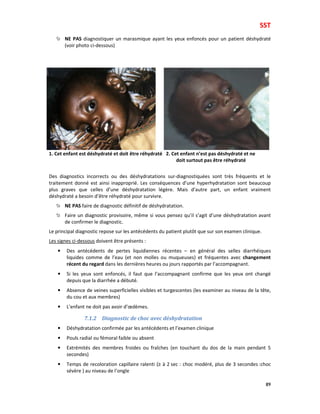 SST
89
NE PAS diagnostiquer un marasmique ayant les yeux enfoncés pour un patient déshydraté
(voir photo ci-dessous)
1. Cet enfant est déshydraté et doit être réhydraté 2. Cet enfant n’est pas déshydraté et ne
doit surtout pas être réhydraté
Des diagnostics incorrects ou des déshydratations sur-diagnostiquées sont très fréquents et le
traitement donné est ainsi inapproprié. Les conséquences d’une hyperhydratation sont beaucoup
plus graves que celles d’une déshydratation légère. Mais d’autre part, un enfant vraiment
déshydraté a besoin d’être réhydraté pour survivre.
NE PAS faire de diagnostic définitif de déshydratation.
Faire un diagnostic provisoire, même si vous pensez qu’il s’agit d’une déshydratation avant
de confirmer le diagnostic.
Le principal diagnostic repose sur les antécédents du patient plutôt que sur son examen clinique.
Les signes ci-dessous doivent être présents :
• Des antécédents de pertes liquidiennes récentes – en général des selles diarrhéiques
liquides comme de l’eau (et non molles ou muqueuses) et fréquentes avec changement
récent du regard dans les dernières heures ou jours rapportés par l’accompagnant.
• Si les yeux sont enfoncés, il faut que l’accompagnant confirme que les yeux ont changé
depuis que la diarrhée a débuté.
• Absence de veines superficielles visibles et turgescentes (les examiner au niveau de la tête,
du cou et aux membres)
• L’enfant ne doit pas avoir d’œdèmes.
7.1.2 Diagnostic de choc avec déshydratation
• Déshydratation confirmée par les antécédents et l’examen clinique
• Pouls radial ou fémoral faible ou absent
• Extrémités des membres froides ou fraîches (en touchant du dos de la main pendant 5
secondes)
• Temps de recoloration capillaire ralenti (≥ à 2 sec : choc modéré, plus de 3 secondes :choc
sévère ) au niveau de l’ongle
 
