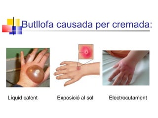 Butllofa causada per cremada:
Líquid calent Exposició al sol Electrocutament
 