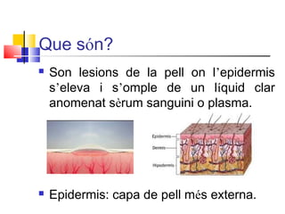 Que són?
 Son lesions de la pell on l’epidermis
s’eleva i s’omple de un líquid clar
anomenat sèrum sanguini o plasma.
 Epidermis: capa de pell més externa.
 