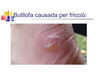 Butllofa causada per fricció:
 