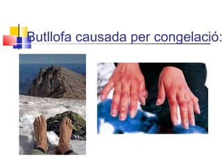 Butllofa causada per congelació:
 