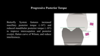 Progressive Posterior Torque
Butterfly System features increased
maxillary posterior torque (–14°) and
reduced mandibular posterior torque (–10°)
to improve intercuspation and posterior
overjet, flatten curve of Wilson, and reduce
interferences.
 