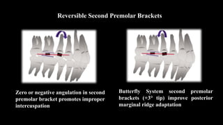 Reversible Second Premolar Brackets
Zero or negative angulation in second
premolar bracket promotes improper
intercuspation
Butterfly System second premolar
brackets (+3° tip) improve posterior
marginal ridge adaptation
 