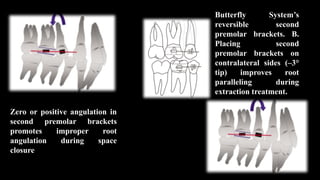 Zero or positive angulation in
second premolar brackets
promotes improper root
angulation during space
closure
Butterfly System’s
reversible second
premolar brackets. B.
Placing second
premolar brackets on
contralateral sides (–3°
tip) improves root
paralleling during
extraction treatment.
 