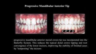Progressive Mandibular Anterior Tip
progressive mandibular anterior mesial crown tip was incorporated into the
Butterfly System. This reduces the typical distal crown tipping and root
convergence of the lower incisors, improving the stability of finished cases
by “tentposting” the incisors
 