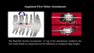 Angulated First Molar Attachments
The Butterfly System incorporates –6° tip of the attachments welded to the
first molar bands to compensate for the difference in marginal ridge heights
 