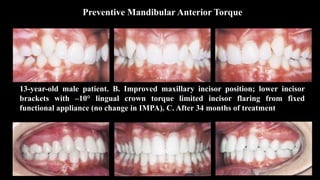 Preventive Mandibular Anterior Torque
13-year-old male patient. B. Improved maxillary incisor position; lower incisor
brackets with –10° lingual crown torque limited incisor flaring from fixed
functional appliance (no change in IMPA). C. After 34 months of treatment
 