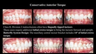 Conservative Anterior Torque
Class II, Division 2 malocclusions often have lingually tipped incisors
These cases require additional labial crown torque to bring the incisors forward and upright.
Butterfly System Design: The maxillary central incisor bracket includes 14° of labial crown
torque.
 
