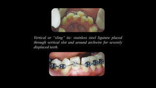 Vertical or “sling” tie: stainless steel ligature placed
through vertical slot and around archwire for severely
displaced teeth.
 