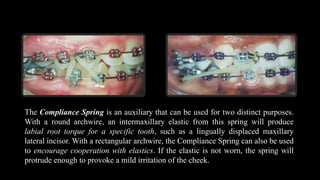 The Compliance Spring is an auxiliary that can be used for two distinct purposes.
With a round archwire, an intermaxillary elastic from this spring will produce
labial root torque for a specific tooth, such as a lingually displaced maxillary
lateral incisor. With a rectangular archwire, the Compliance Spring can also be used
to encourage cooperation with elastics. If the elastic is not worn, the spring will
protrude enough to provoke a mild irritation of the cheek.
 