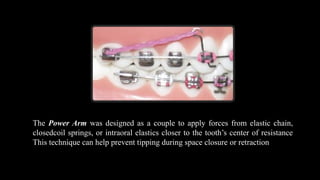 The Power Arm was designed as a couple to apply forces from elastic chain,
closedcoil springs, or intraoral elastics closer to the tooth’s center of resistance
This technique can help prevent tipping during space closure or retraction
 
