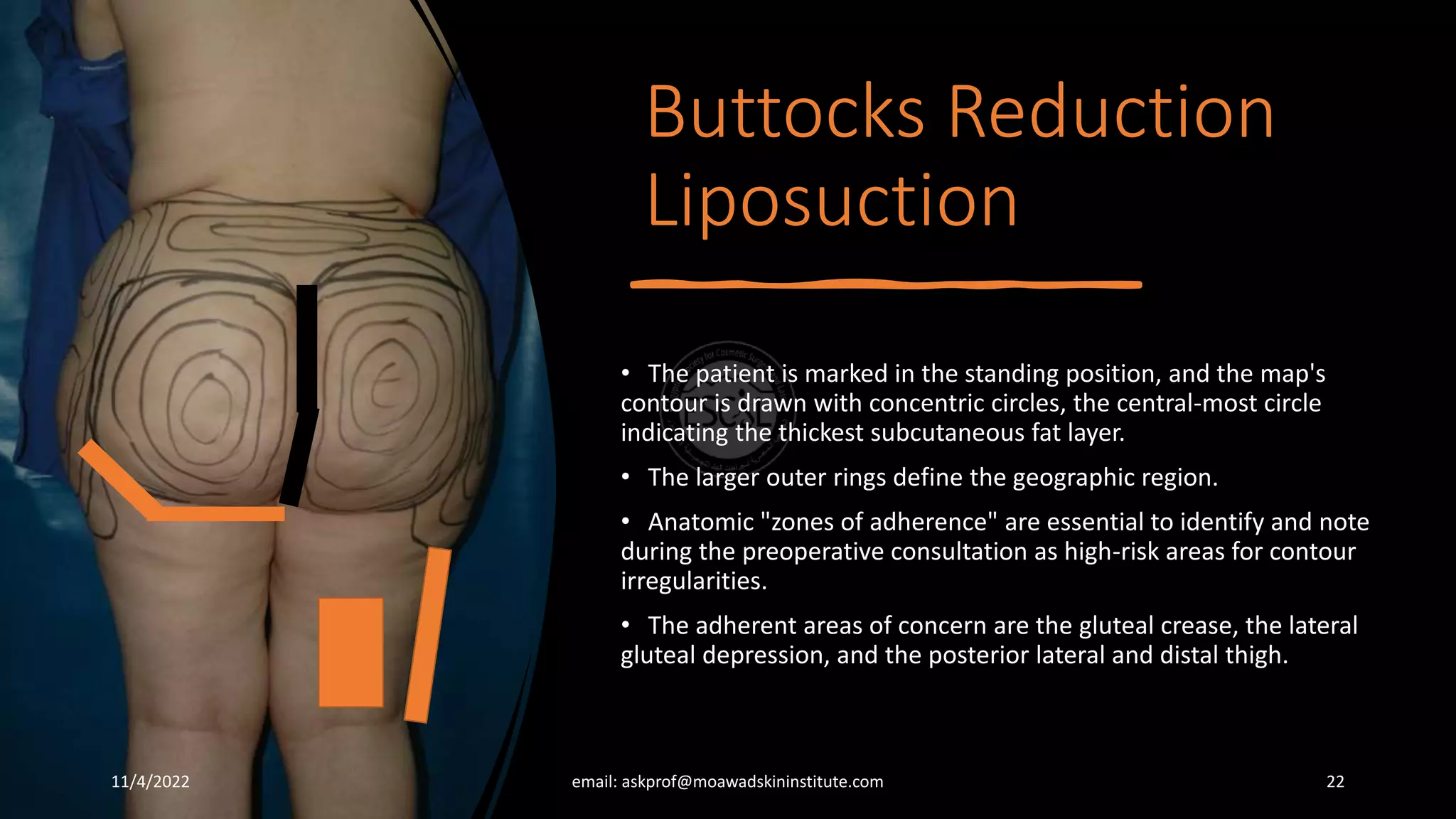 Buttocks Reduction Liposuction and Lipofilling-Egyptian Buttocks.pptx