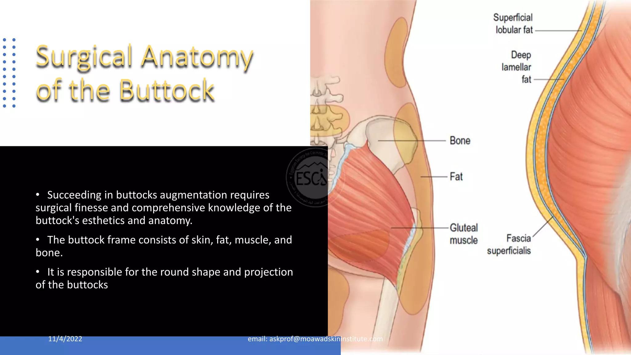 Buttocks Reduction Liposuction and Lipofilling-Egyptian Buttocks.pptx