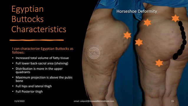 Buttocks Reduction Liposuction and Lipofilling-Egyptian Buttocks.pptx