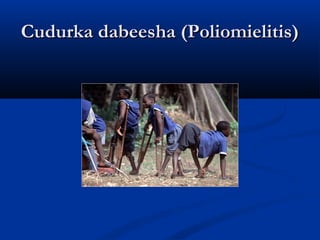 Cudurka Dabeesha (poliomielitis)Cudurka Dabeesha (poliomielitis)
 