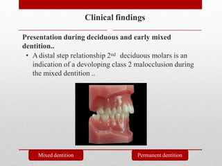 Clinical findings
Presentation during deciduous and early mixed
dentition..
• Adistal step relationship 2nd deciduous molars is an
indication of a devoloping class 2 malocclusion during
the mixed dentition ..
Mixed dentition Permanent dentition
 