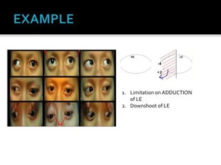 1. Limitation on ADDUCTION
of LE
2. Downshoot of LE
 