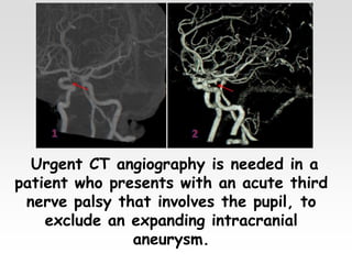 Urgent CT angiography is needed in a
patient who presents with an acute third
nerve palsy that involves the pupil, to
exclude an expanding intracranial
aneurysm.
 